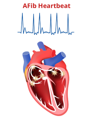 Heart graphic showing AFib heartbeat.